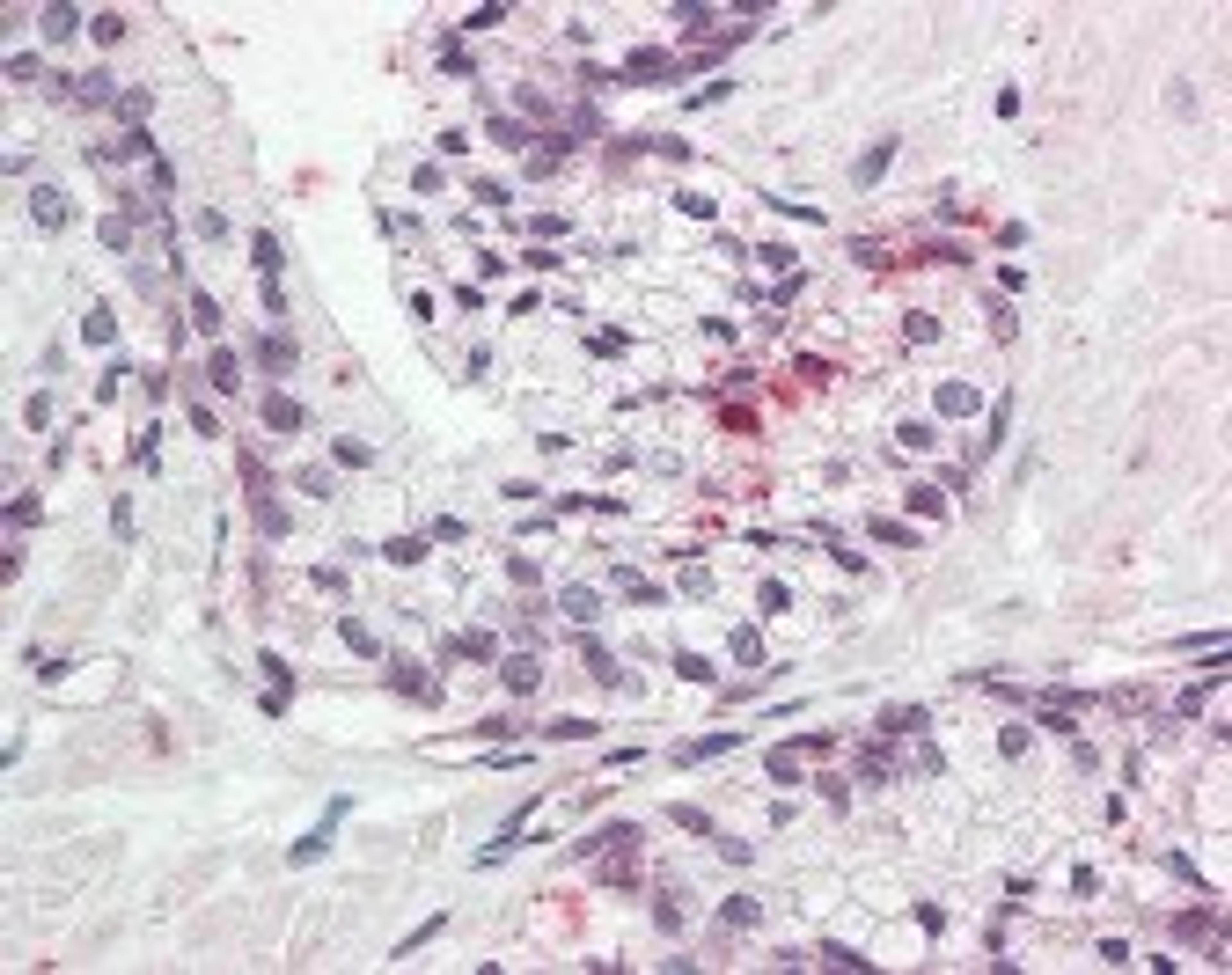 Immunohistochemistry staining of Kallikrein 11 in prostate: formalin-fixed, paraffin-embedded (ffpe)Kallikrein 11 Antibody.