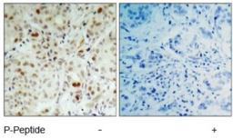 Immunohistochemistry: Retinoblastoma 1 [p Ser807] Antibody [NB100-82177] - Immunohistochemical analysis of paraffin- embedded human breast carcinoma tissue using Rb (phospho-Ser807) antibody