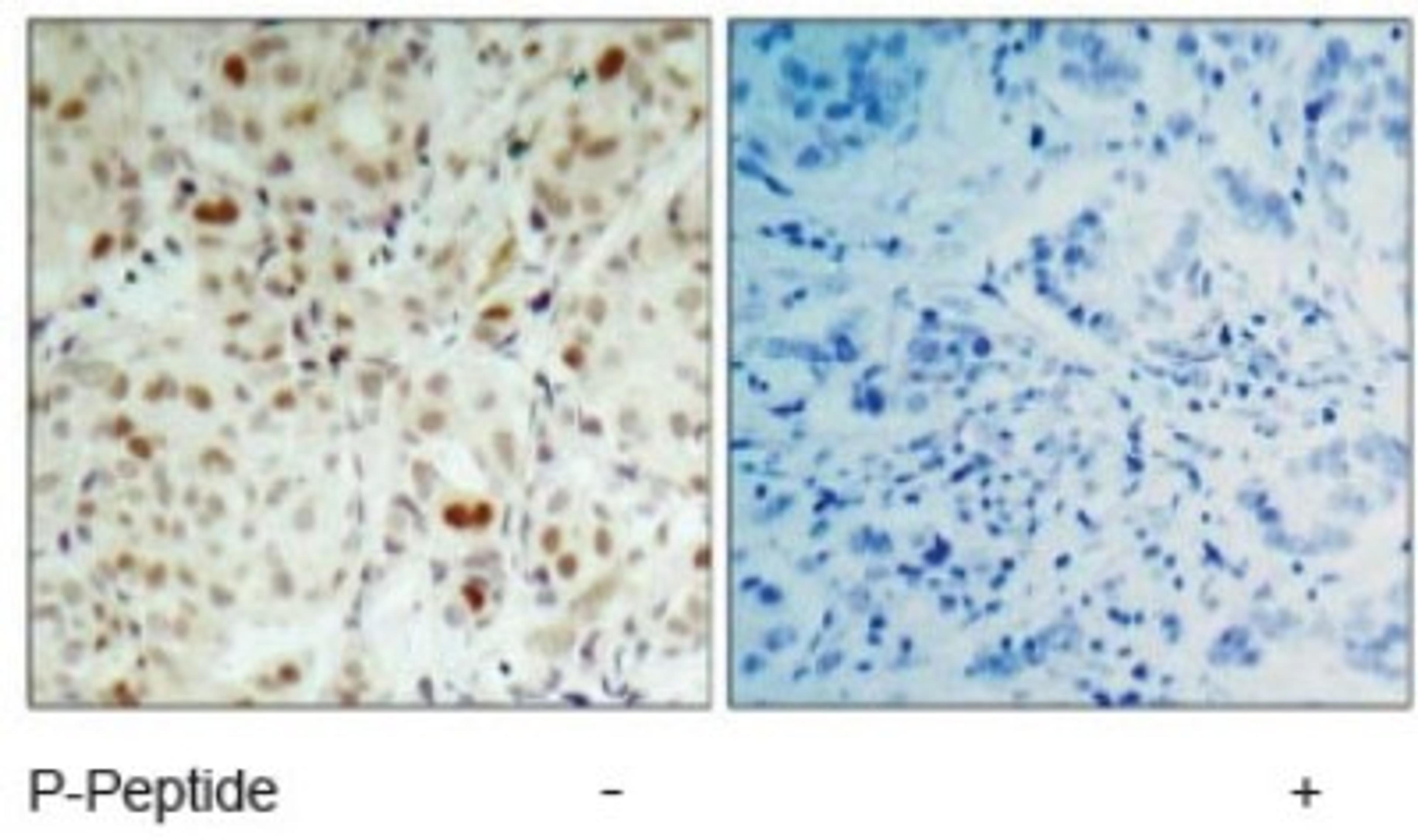 Immunohistochemistry: Retinoblastoma 1 [p Ser807] Antibody [NB100-82177] - Immunohistochemical analysis of paraffin- embedded human breast carcinoma tissue using Rb (phospho-Ser807) antibody