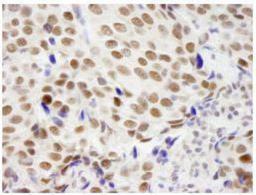 Immunohistochemistry-Paraffin: ZMYM3 Antibody [NB100-458] - FFPE section of human breast adenocarcinoma.  Affinity purified rabbit anti-ZMYM3 used at a dilution of 1:250. Detection: DAB  staining using Immunohistochemistry Accessory Kit