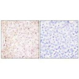 Immunohistochemical analysis of paraffin-embedded human breast carcinoma tissue using Stefin B antibody.