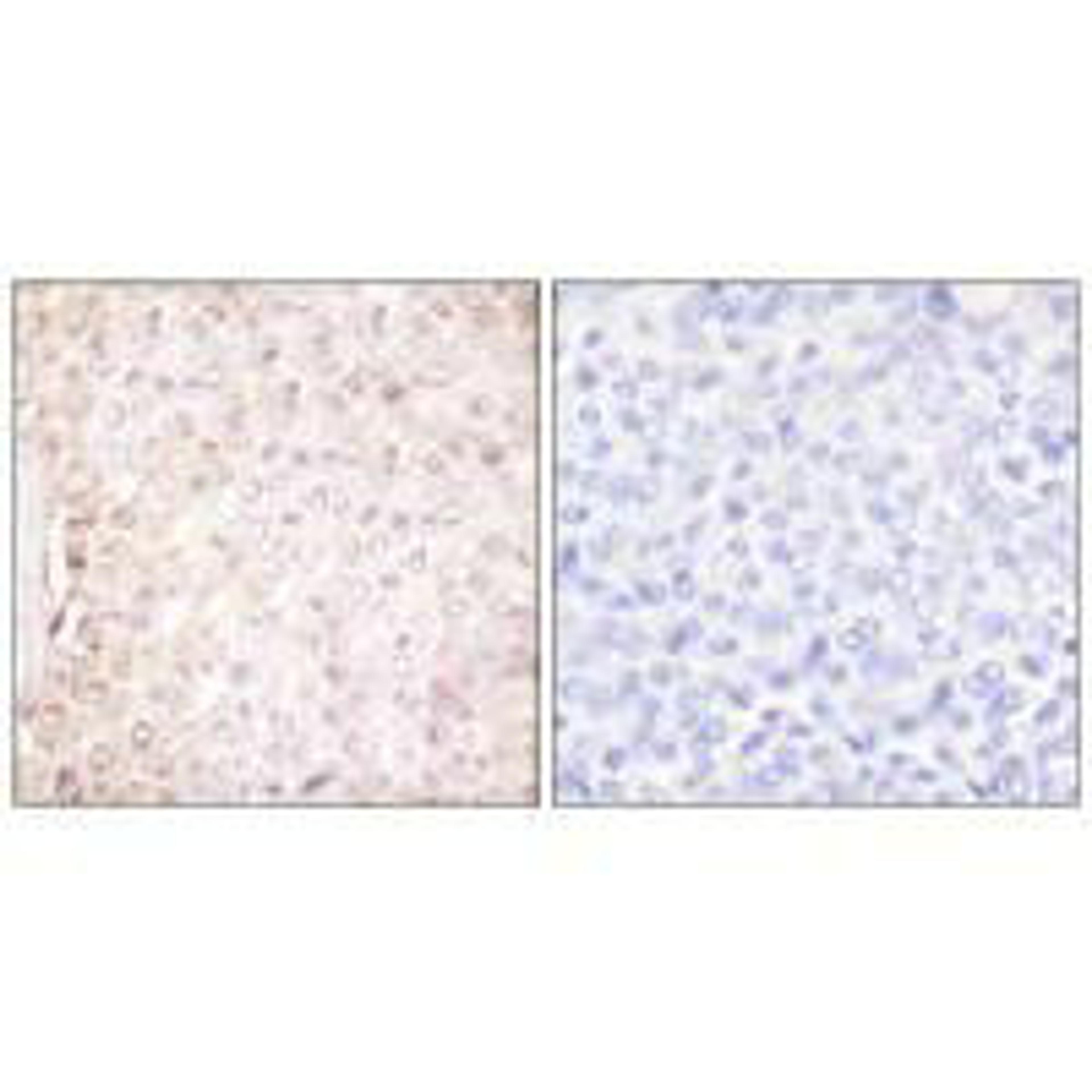 Immunohistochemical analysis of paraffin-embedded human breast carcinoma tissue using Stefin B antibody.