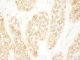 Immunohistochemistry-Paraffin: ARHGEF16 Antibody [NBP1-06499] - Section of human breast carcinoma. Antibody:  Affinity purified rabbit anti-ARHGEF16 used at a dilution of 1:250. Detection: DAB staining using  Immunohistochemistry Accessory Kit