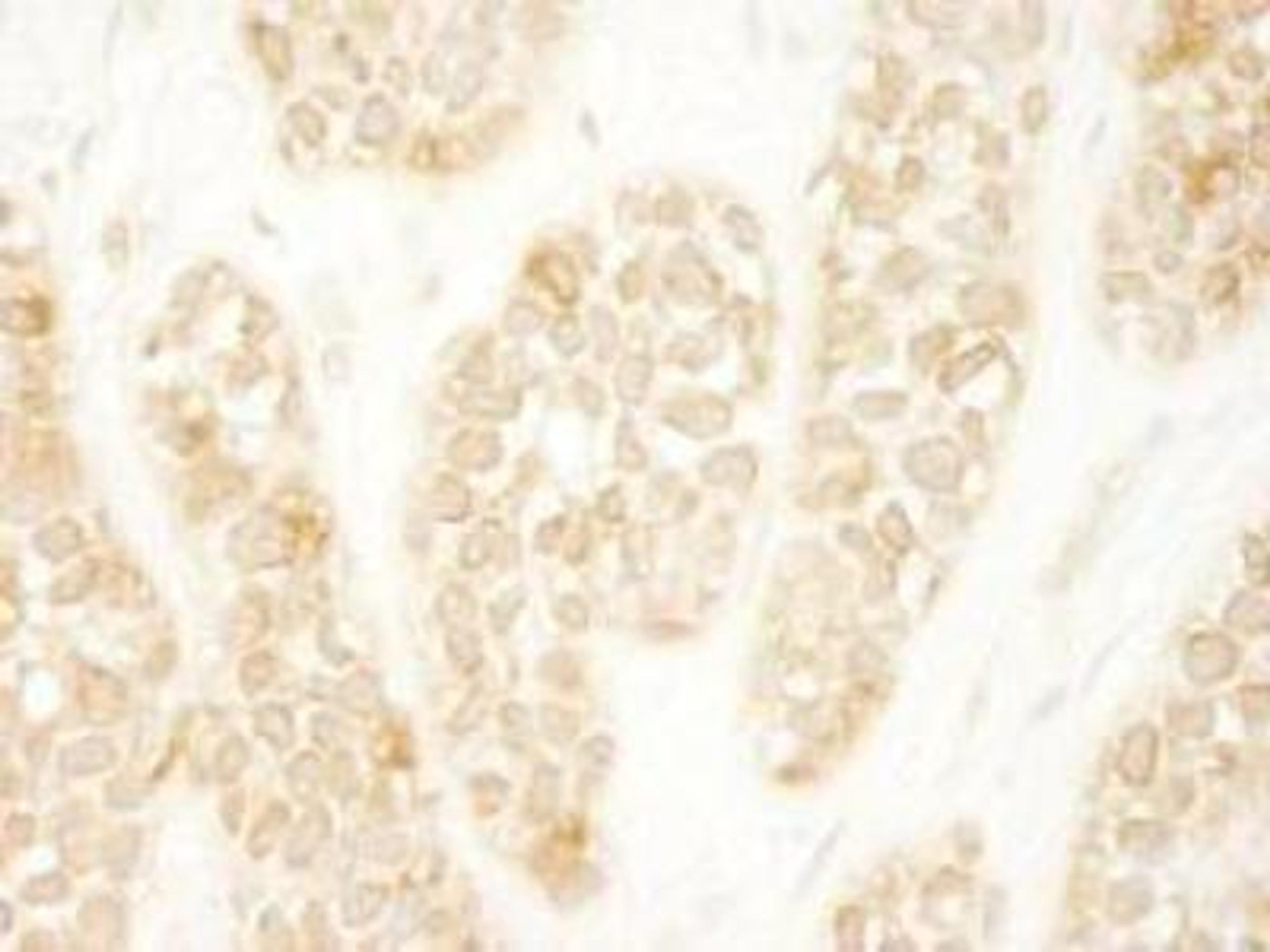 Immunohistochemistry-Paraffin: ARHGEF16 Antibody [NBP1-06499] - Section of human breast carcinoma. Antibody:  Affinity purified rabbit anti-ARHGEF16 used at a dilution of 1:250. Detection: DAB staining using  Immunohistochemistry Accessory Kit