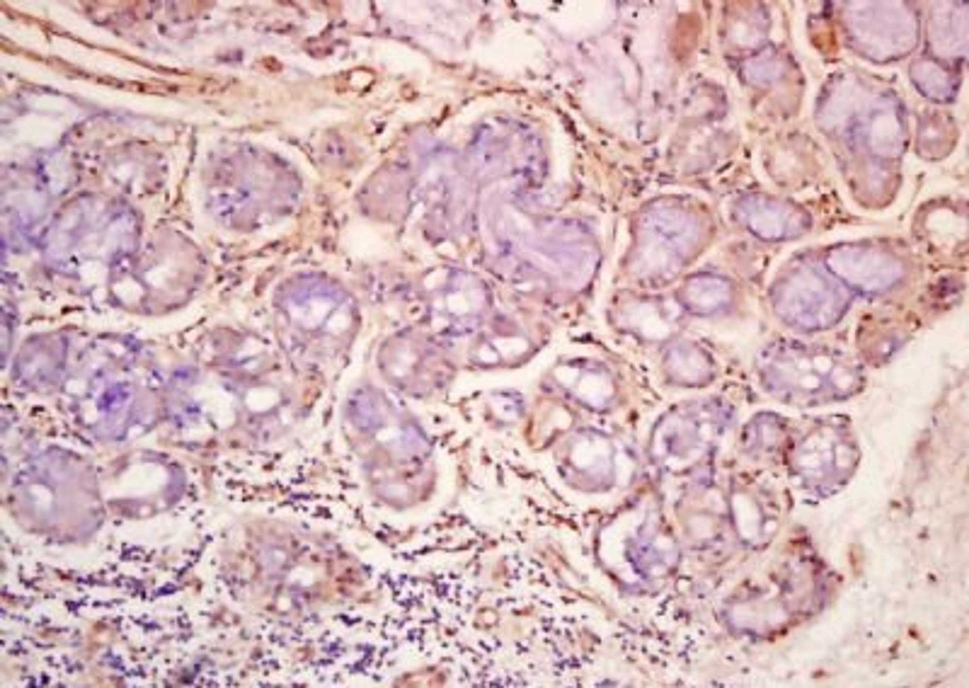 Immunohistochemical analysis of formalin-fixed paraffin embedded human lung carcinoma using ERK5 (phospho-Ser496) antibody (dilution at 1:200)