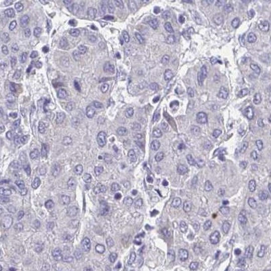 Immunohistochemistry: ZNF483 Antibody [NBP2-31592] - liver cancer