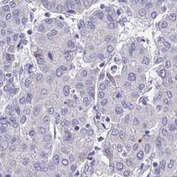 Immunohistochemistry: ZNF483 Antibody [NBP2-31592] - liver cancer