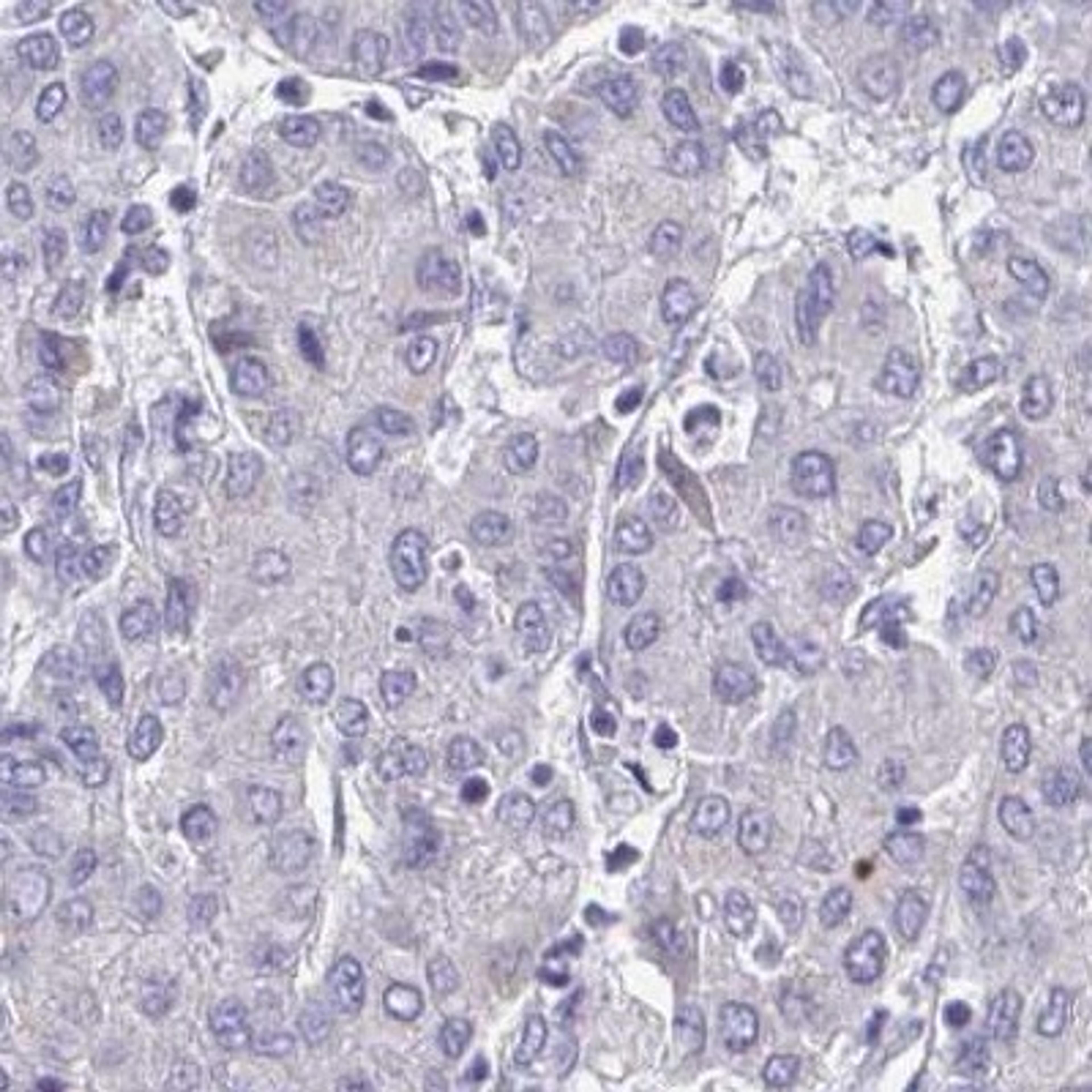 Immunohistochemistry: ZNF483 Antibody [NBP2-31592] - liver cancer