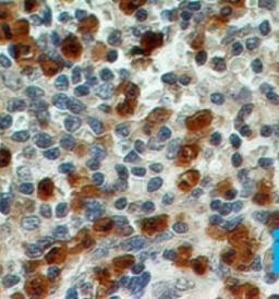 Immunohistochemistry-Paraffin: S100A8/A9 Antibody (48M7C7) [Azide Free] [NBP2-25269] - Formalin-fixed, paraffin-embedded human spleen stained with S100A8 antibody (2 ug/ml), peroxidase-conjugate and DAB chromogen. TMA was used for this test.