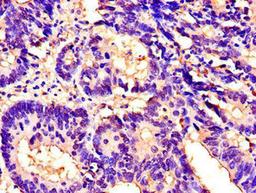 Immunohistochemistry of paraffin-embedded human colon cancer using CSB-PA011876LA01HU at dilution of 1:100