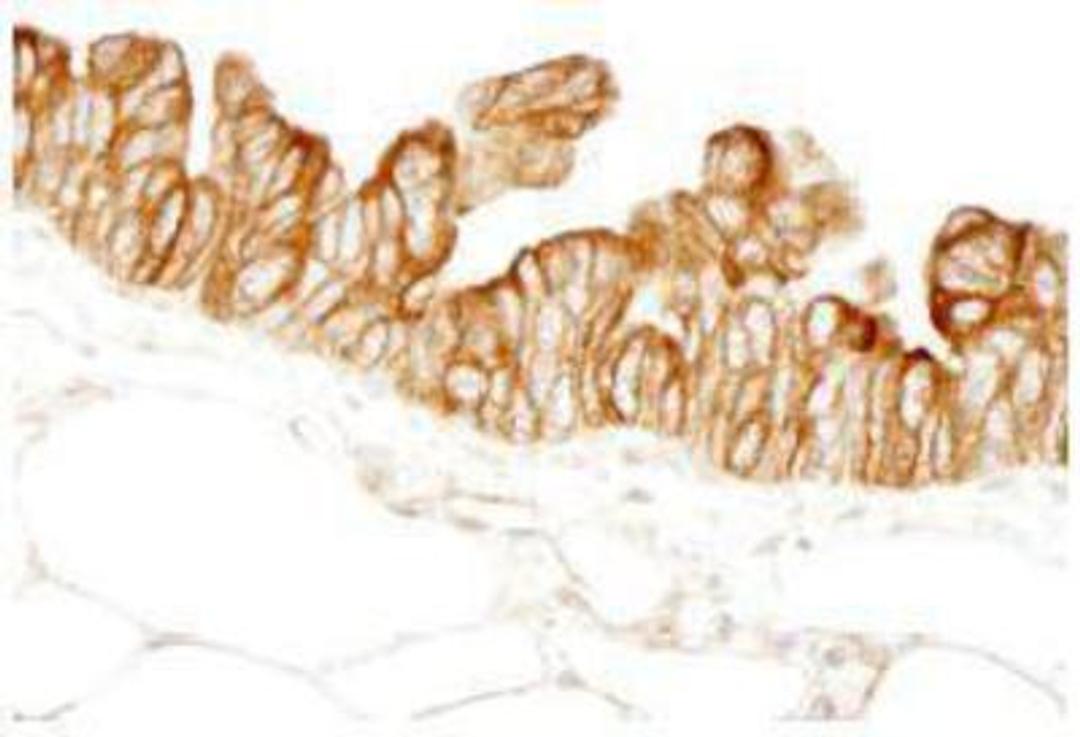 Immunohistochemistry-Paraffin: PBXIP1 Antibody [NB100-81652] - FFPE section of human ovarian carcinoma. Affinity purified rabbit anti-HPIP used at a dilution of 1:100. Detection: DAB staining using Immunohistochemistry Accessory Kit