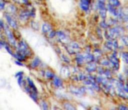 Immunohistochemistry-Paraffin: COL1A2 Antibody [NBP1-19699] - Human colon carcinoma tissue.