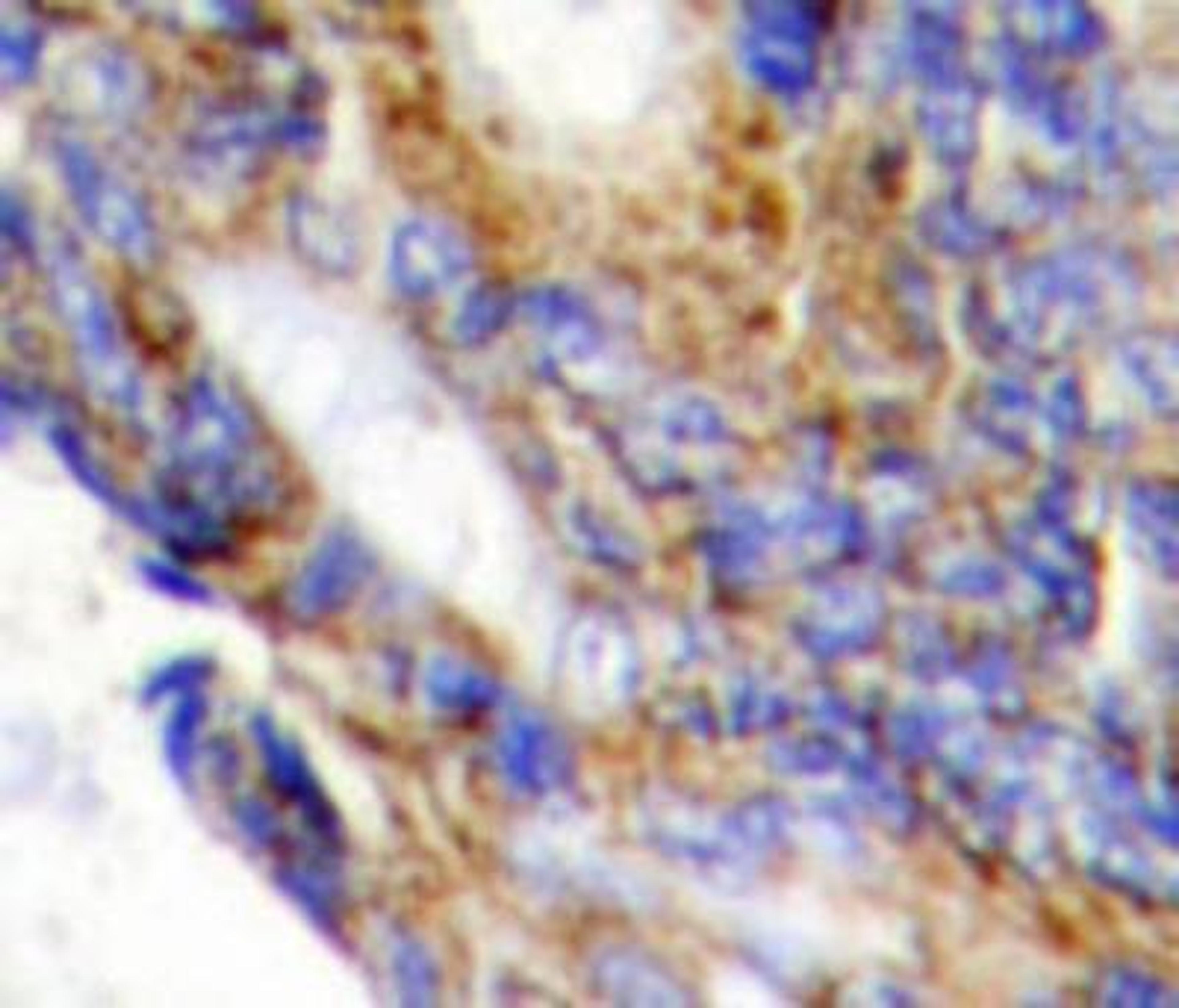 Immunohistochemistry-Paraffin: COL1A2 Antibody [NBP1-19699] - Human colon carcinoma tissue.