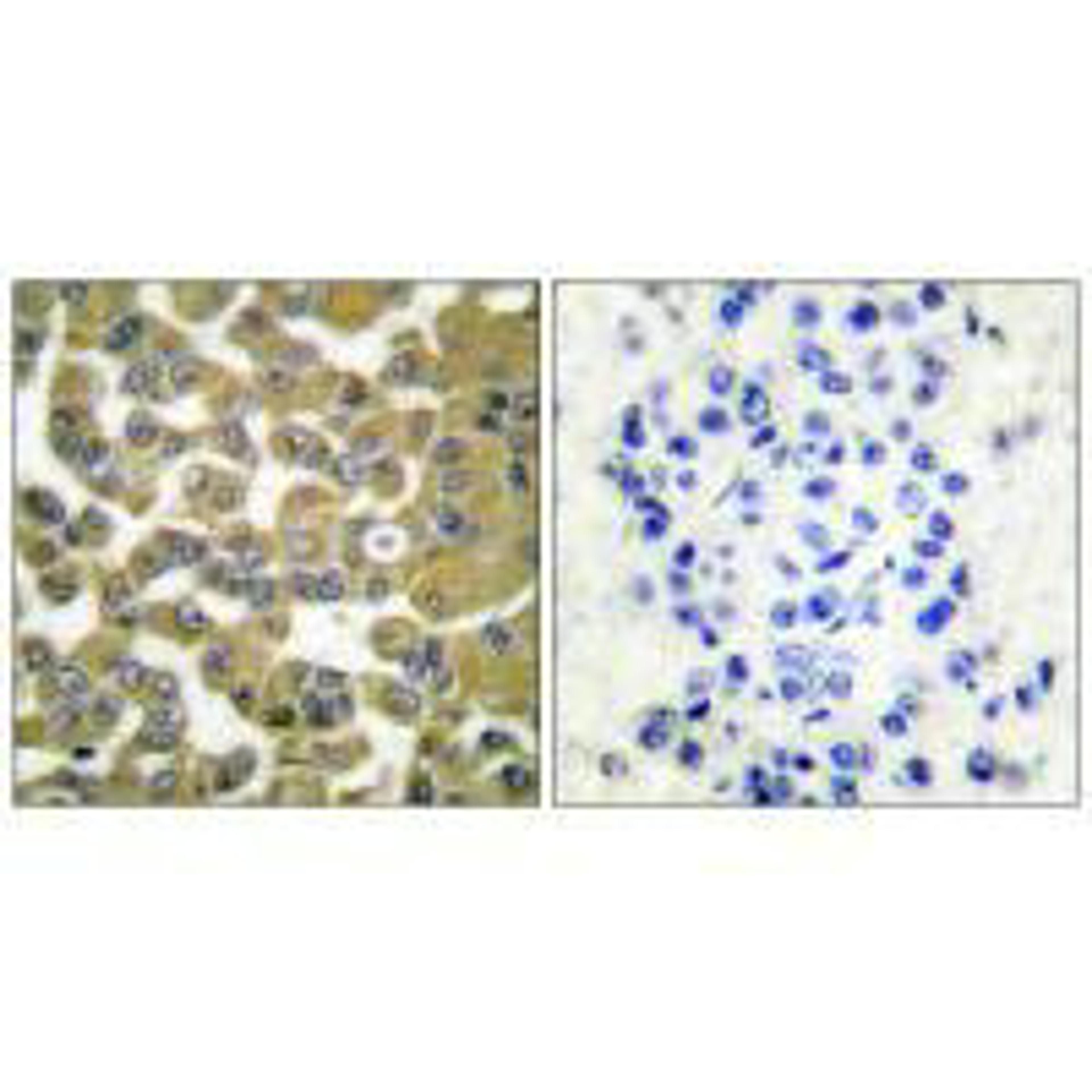 Immunohistochemical analysis of paraffin-embedded human breast carcinoma tissue using MMP-11 antibody.