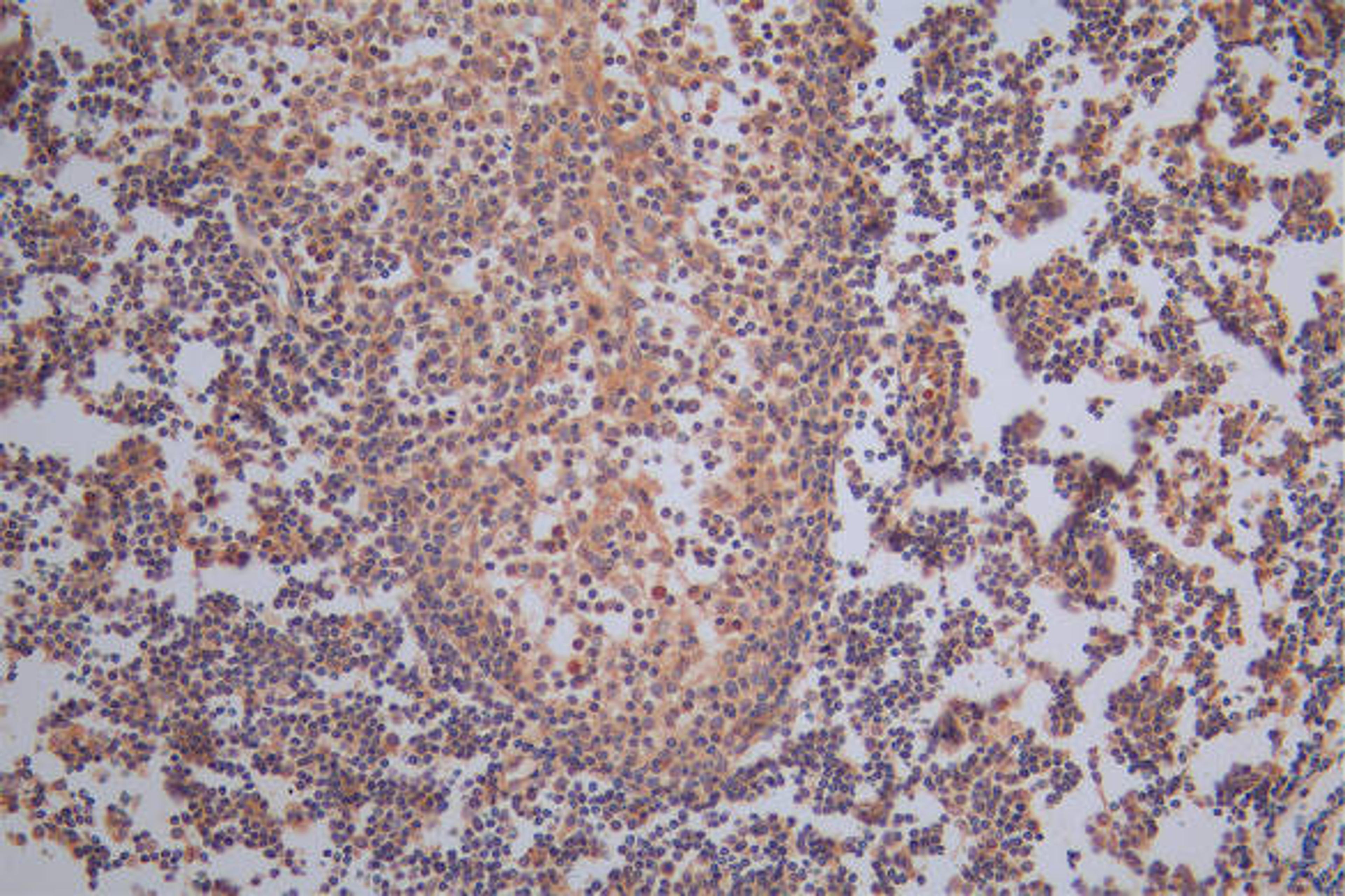 IHC image of CSB-RA008642MA1HU diluted at 1:50 and staining in paraffin-embedded human tonsil tissue performed on a Leica BondTM system. After dewaxing and hydration,  antigen retrieval was mediated by high pressure in a citrate buffer (pH 6.0). Section was blocked with 10% normal goat serum 30min at RT. Then primary antibody (1% BSA) was incubated at 4°C overnight. The primary is detected by a Goat anti-Rabbit IgG labeled by HRP and visualized using 0.05% DAB.