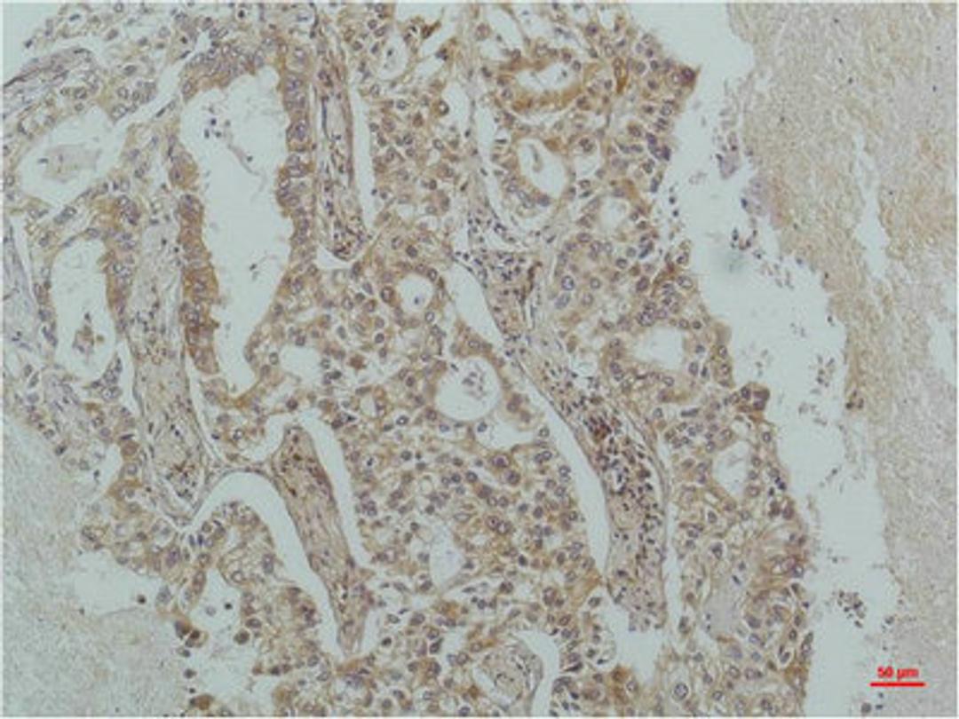 Immunohistochemical analysis of paraffin-embedded Human Lung Carcinoma using IκB β(mAb diluted at 1:200.