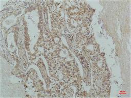 Immunohistochemical analysis of paraffin-embedded Human Lung Carcinoma using IκB β(mAb diluted at 1:200.