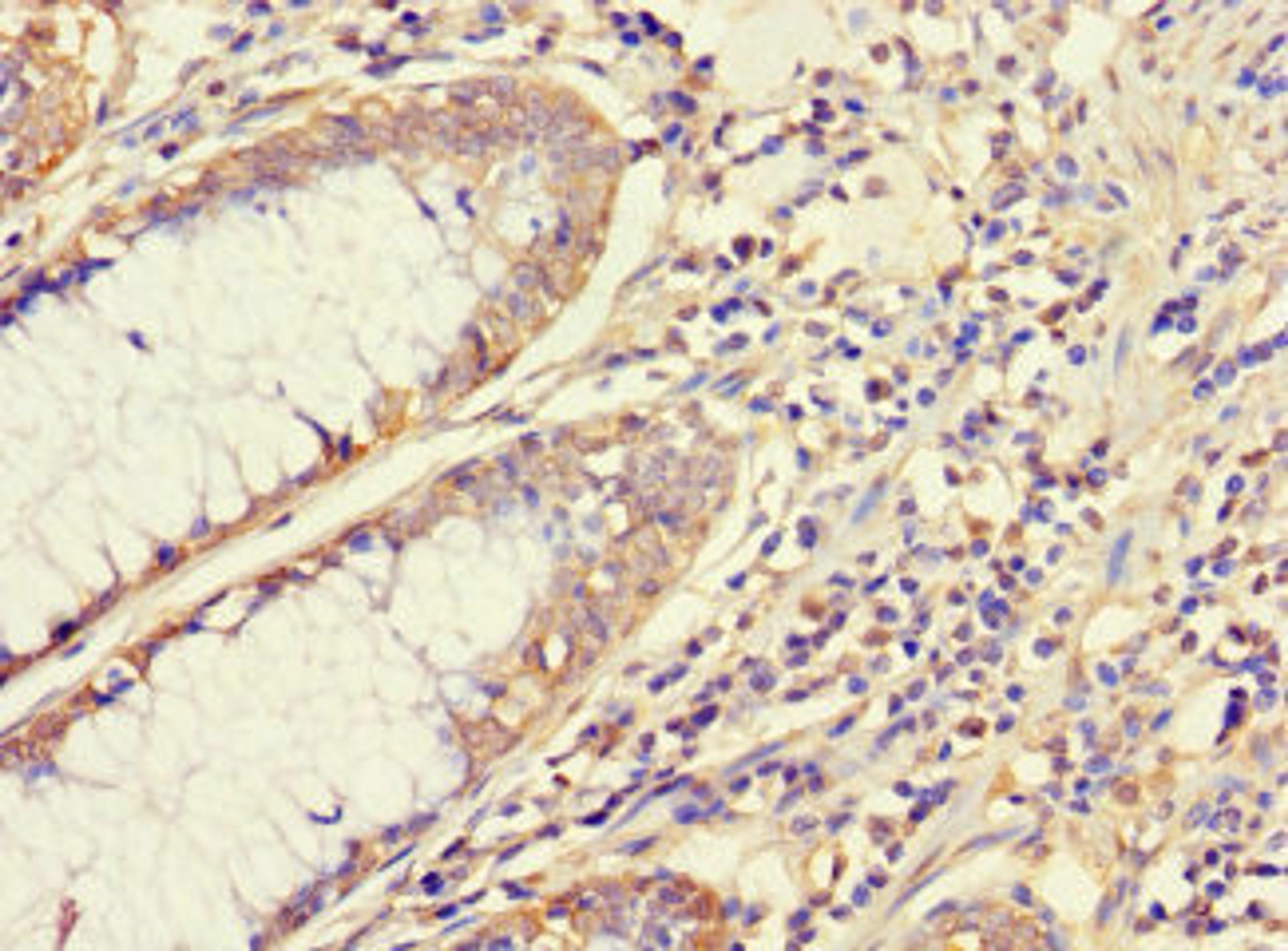 Immunohistochemistry of paraffin-embedded human colon cancer using CSB-PA15499A0Rb at dilution of 1:100