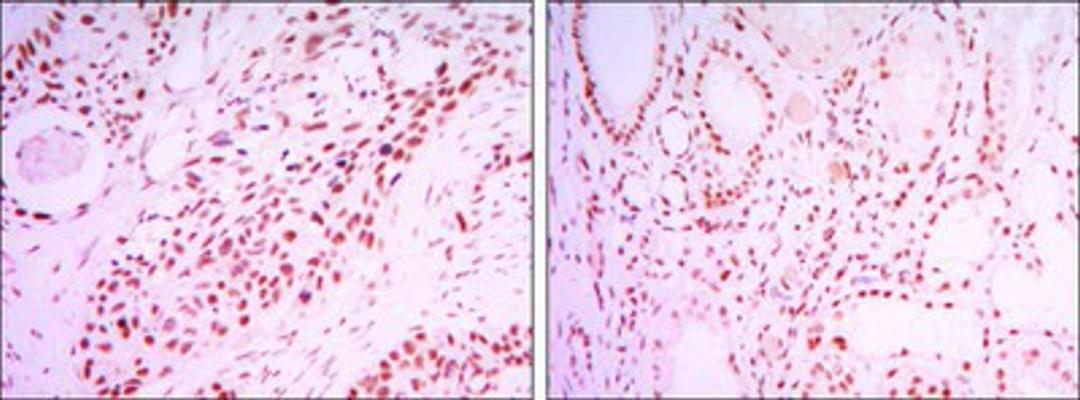 Immunohistochemistry-Paraffin: SIRT1 Antibody (1F3) [NBP1-51641] - Immunohistochemical analysis of paraffin-embedded lung cancer tissues (left) and kidney cancer tissues (right) using SIRT1 mouse mAb with DAB staining.