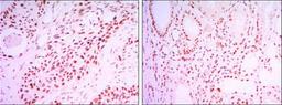 Immunohistochemistry-Paraffin: SIRT1 Antibody (1F3) [NBP1-51641] - Immunohistochemical analysis of paraffin-embedded lung cancer tissues (left) and kidney cancer tissues (right) using SIRT1 mouse mAb with DAB staining.