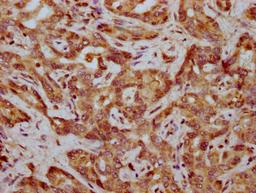 IHC image of CSB-PA008345LA01HU diluted at 1:400 and staining in paraffin-embedded human liver cancer performed on a Leica BondTM system. After dewaxing and hydration, antigen retrieval was mediated by high pressure in a citrate buffer (pH 6.0). Section was blocked with 10% normal goat serum 30min at RT. Then primary antibody (1% BSA) was incubated at 4&deg;C overnight. The primary is detected by a biotinylated secondary antibody and visualized using an HRP conjugated SP system.