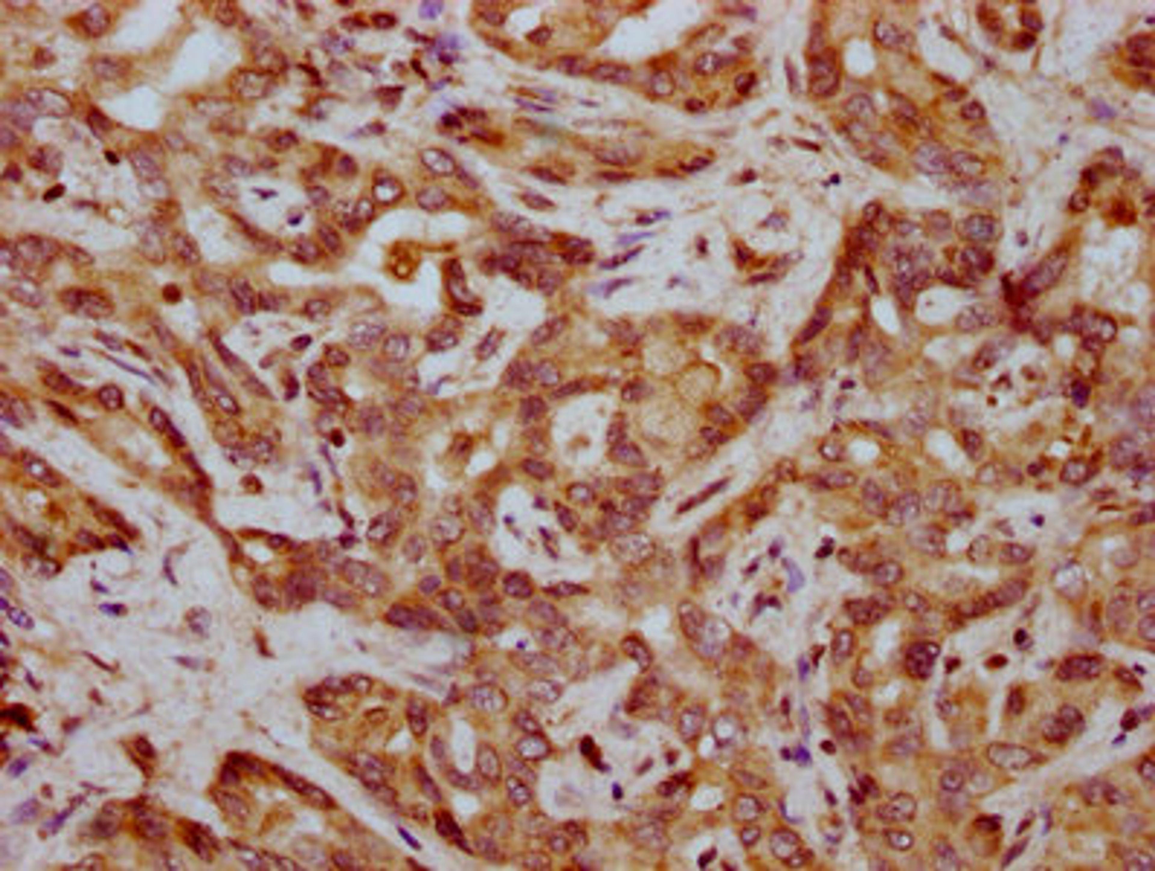 IHC image of CSB-PA008345LA01HU diluted at 1:400 and staining in paraffin-embedded human liver cancer performed on a Leica BondTM system. After dewaxing and hydration, antigen retrieval was mediated by high pressure in a citrate buffer (pH 6.0). Section was blocked with 10% normal goat serum 30min at RT. Then primary antibody (1% BSA) was incubated at 4&deg;C overnight. The primary is detected by a biotinylated secondary antibody and visualized using an HRP conjugated SP system.