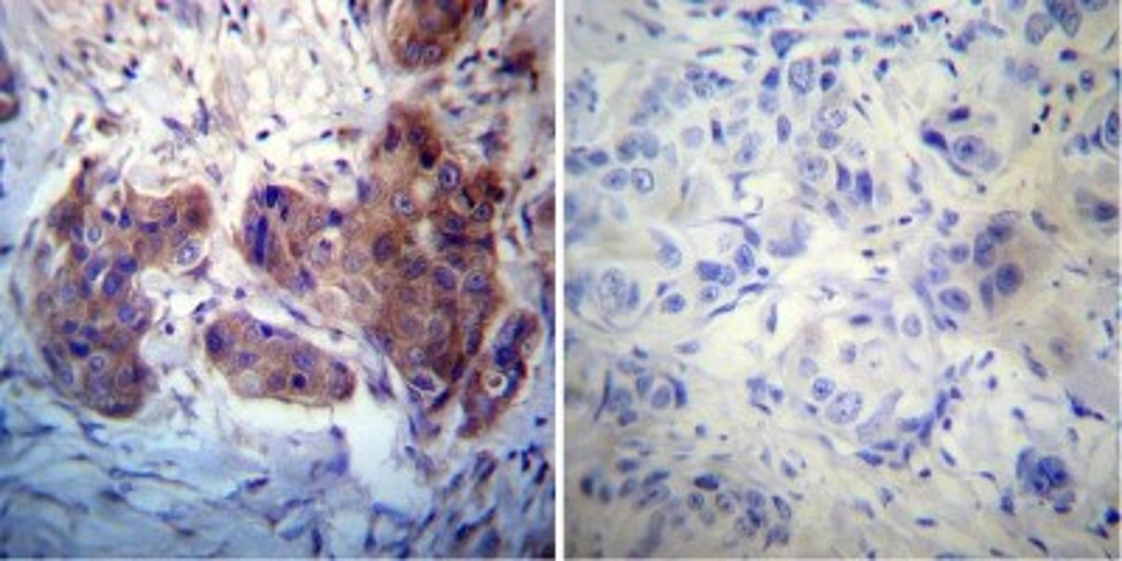 Immunohistochemistry-Paraffin: Rab4 Antibody [NB100-74519] - Both normal and cancer biopsies of deparaffinized human Breast carcinoma tissue.