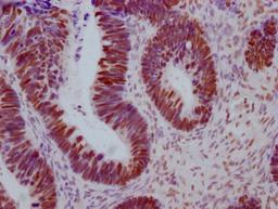IHC image of CSB-MA442659 diluted at 1:100 and staining in paraffin-embedded human ovarian cancer performed on a Leica BondTM system. After dewaxing and hydration, antigen retrieval was mediated by high pressure in a citrate buffer (pH 6.0). Section was blocked with 10% normal goat serum 30min at RT. Then primary antibody (1% BSA) was incubated at 4°C overnight. The primary is detected by a Goat anti-mouse IgG polymer labeled by HRP and visualized using 0.05% DAB.