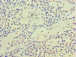 Immunohistochemistry of paraffin-embedded human breast cancer using CSB-PA878922DSR2HU at dilution of 1:100
