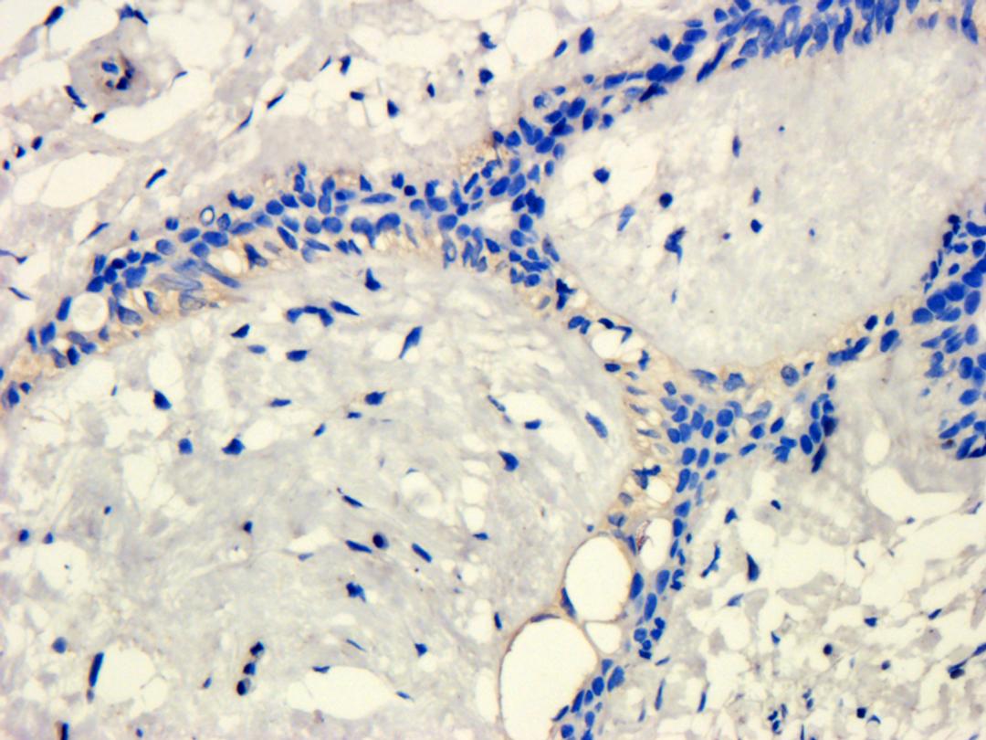 IHC-P image of human breast cancer tissue using anti-KLKB1 (dilution of primary antibody at 1:100)