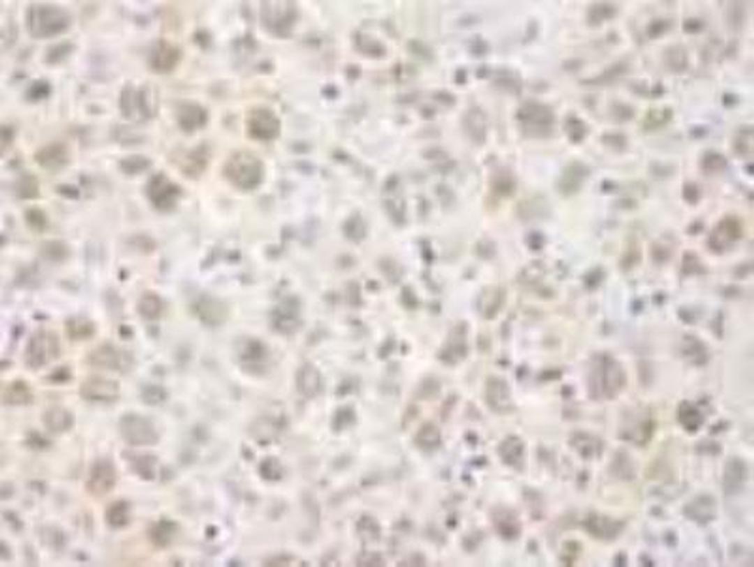 Immunohistochemistry-Paraffin: BAAT1 Antibody [NB100-2256] - FFPE section of human metastatic lymph node. NB100-2256 used at a dilution of 1:250.