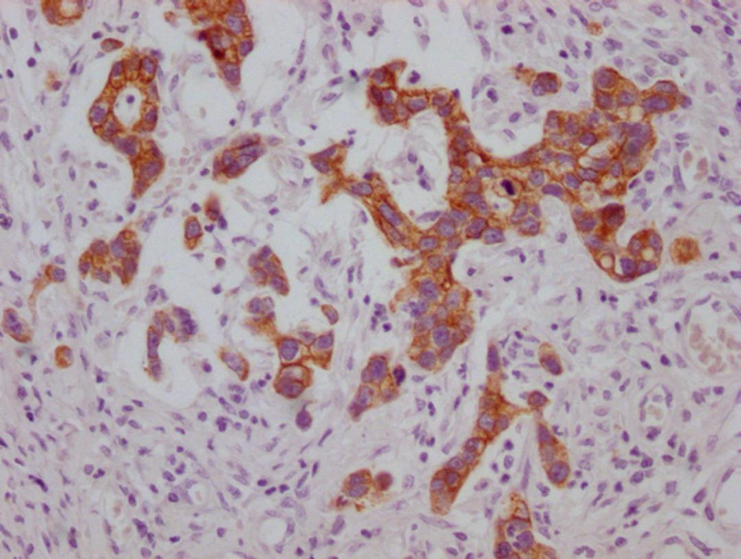 IHC image of CSB-MA974483 diluted at 1:100 and staining in paraffin-embedded human gastric cancer performed on a Leica BondTM system. After dewaxing and hydration, antigen retrieval was mediated by high pressure in a citrate buffer (pH 6.0). Section was blocked with 10% normal goat serum 30min at RT. Then primary antibody (1% BSA) was incubated at 4°C overnight. The primary is detected by a Goat anti-mouse IgG polymer labeled by HRP and visualized using 0.05% DAB.