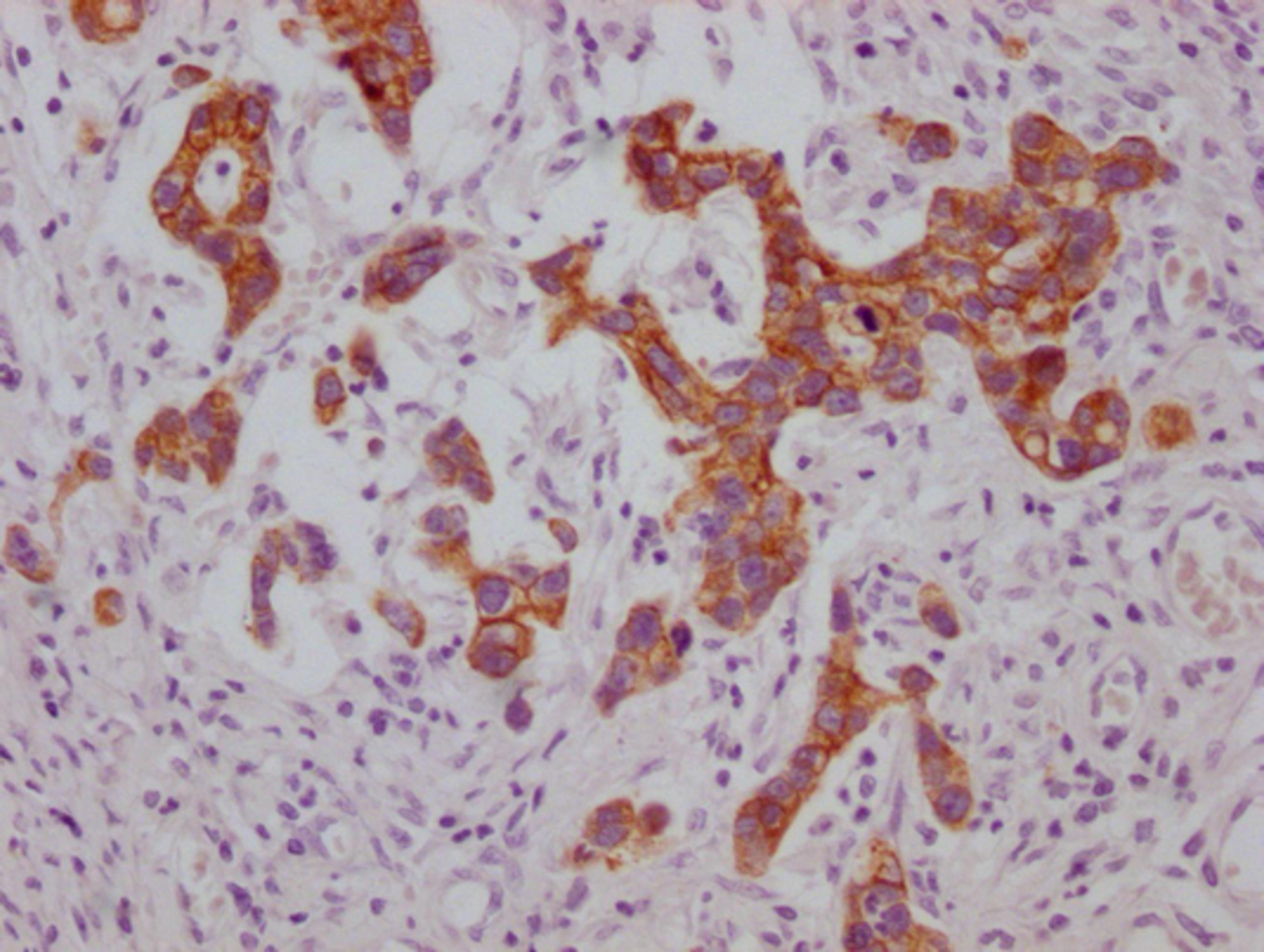 IHC image of CSB-MA974483 diluted at 1:100 and staining in paraffin-embedded human gastric cancer performed on a Leica BondTM system. After dewaxing and hydration, antigen retrieval was mediated by high pressure in a citrate buffer (pH 6.0). Section was blocked with 10% normal goat serum 30min at RT. Then primary antibody (1% BSA) was incubated at 4°C overnight. The primary is detected by a Goat anti-mouse IgG polymer labeled by HRP and visualized using 0.05% DAB.