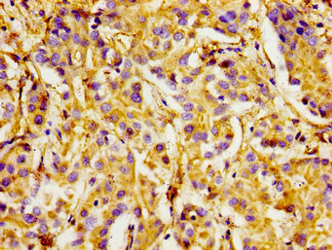 Immunohistochemistry of paraffin-embedded human liver cancer using CSB-PA011861LA01HU at dilution of 1:100