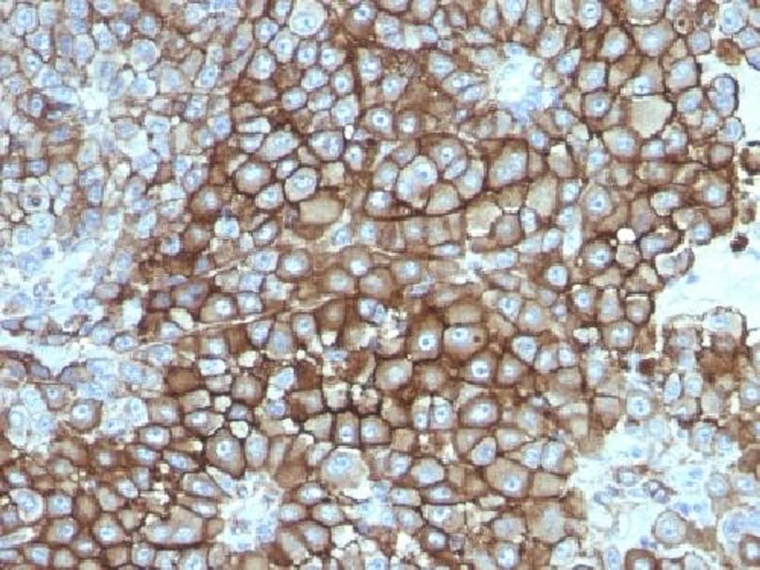 Immunohistochemical staining of human Melanoma tissue using KBA.62 antibody