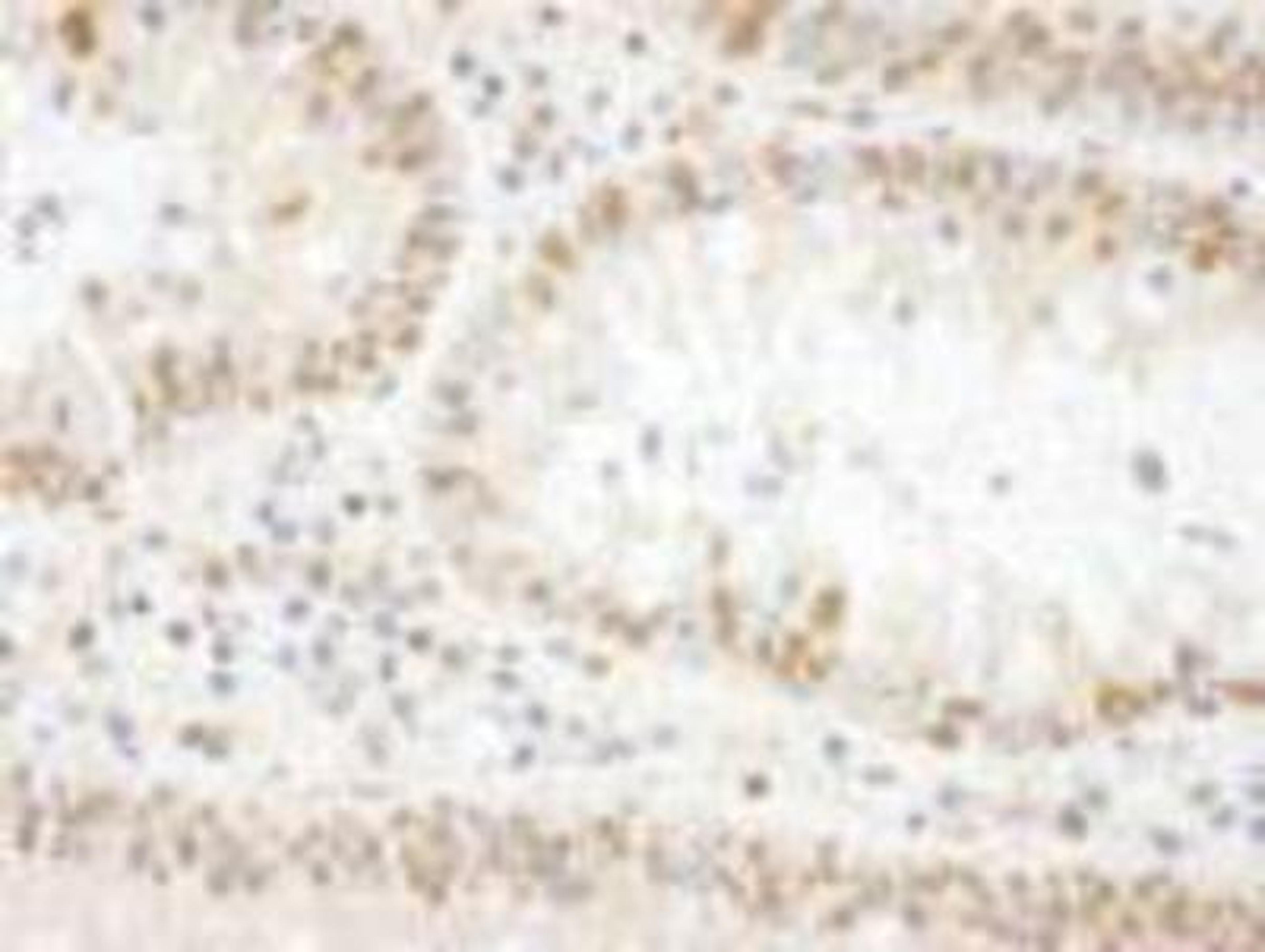 Immunohistochemistry-Paraffin: BOP1 Antibody [NBP1-21389] - FFPE section of human colon carcinoma.  Affinity purified rabbit anti-BOP1 used at a dilution of 1:250.