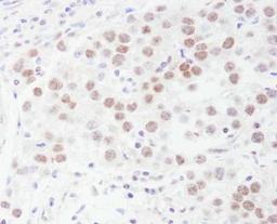 Immunohistochemistry-Paraffin: DDX1 Antibody [NB200-349] - Human testicular seminoma.