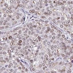 Immunohistochemistry: FAM122A Antibody [NBP2-31646] - liver cancer