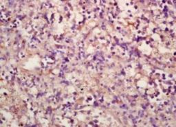 Immunohistochemical staining of human rectal carcinoma tissue using CXCR2 antibody