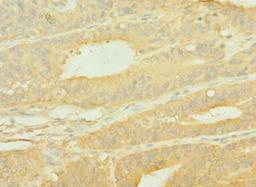 Immunohistochemistry of paraffin-embedded human endometrial cancer using CSB-PA622519LA01HU at dilution of 1:100