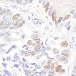 Detection of human p53 by immunohistochemistry.