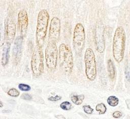 Immunohistochemistry-Paraffin: NOC3L Antibody [NBP1-26590] - Human colon carcinoma.  Antibody used at a dilution of 1:1,000.