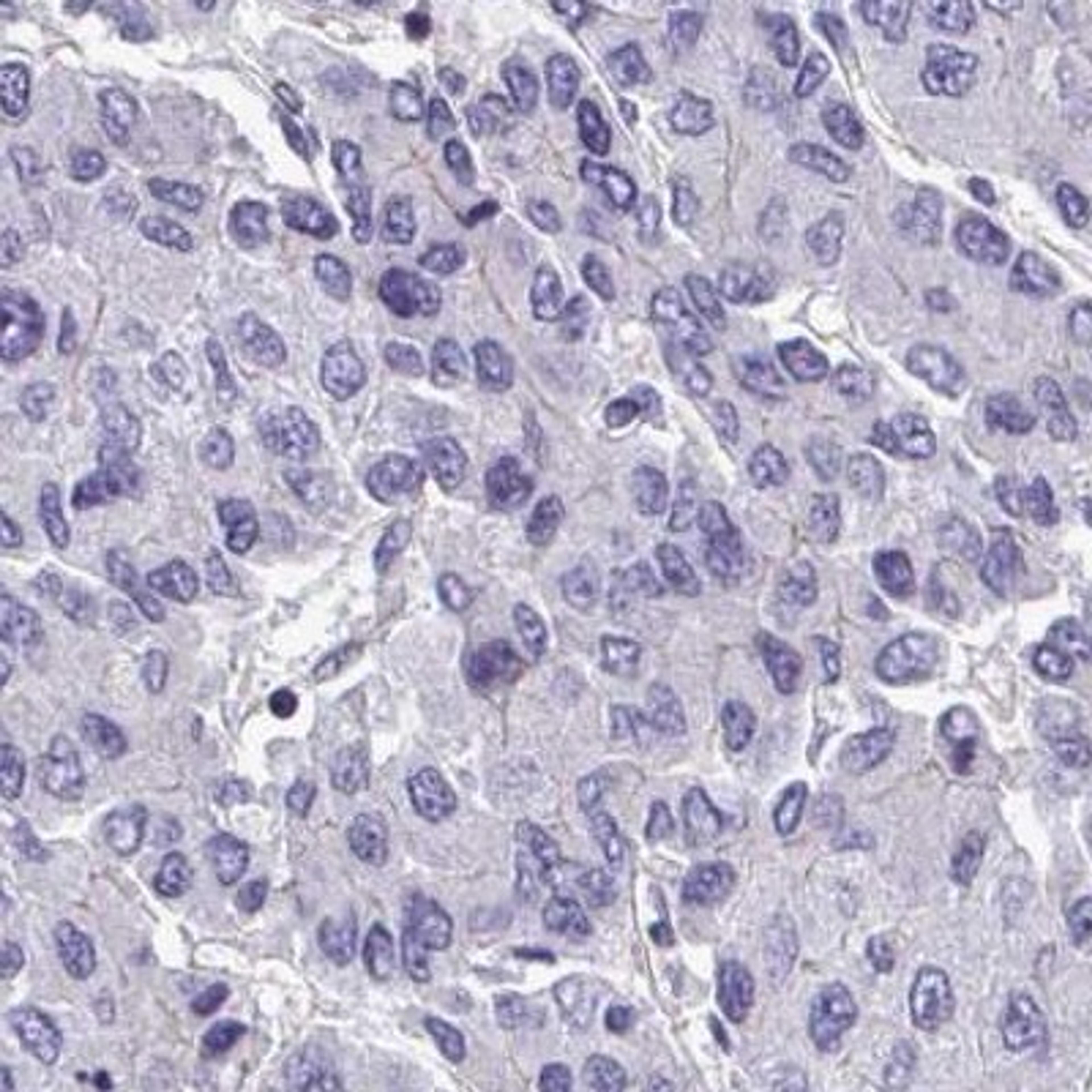 Immunohistochemistry: SHISA7 Antibody [NBP2-32407] - liver cancer