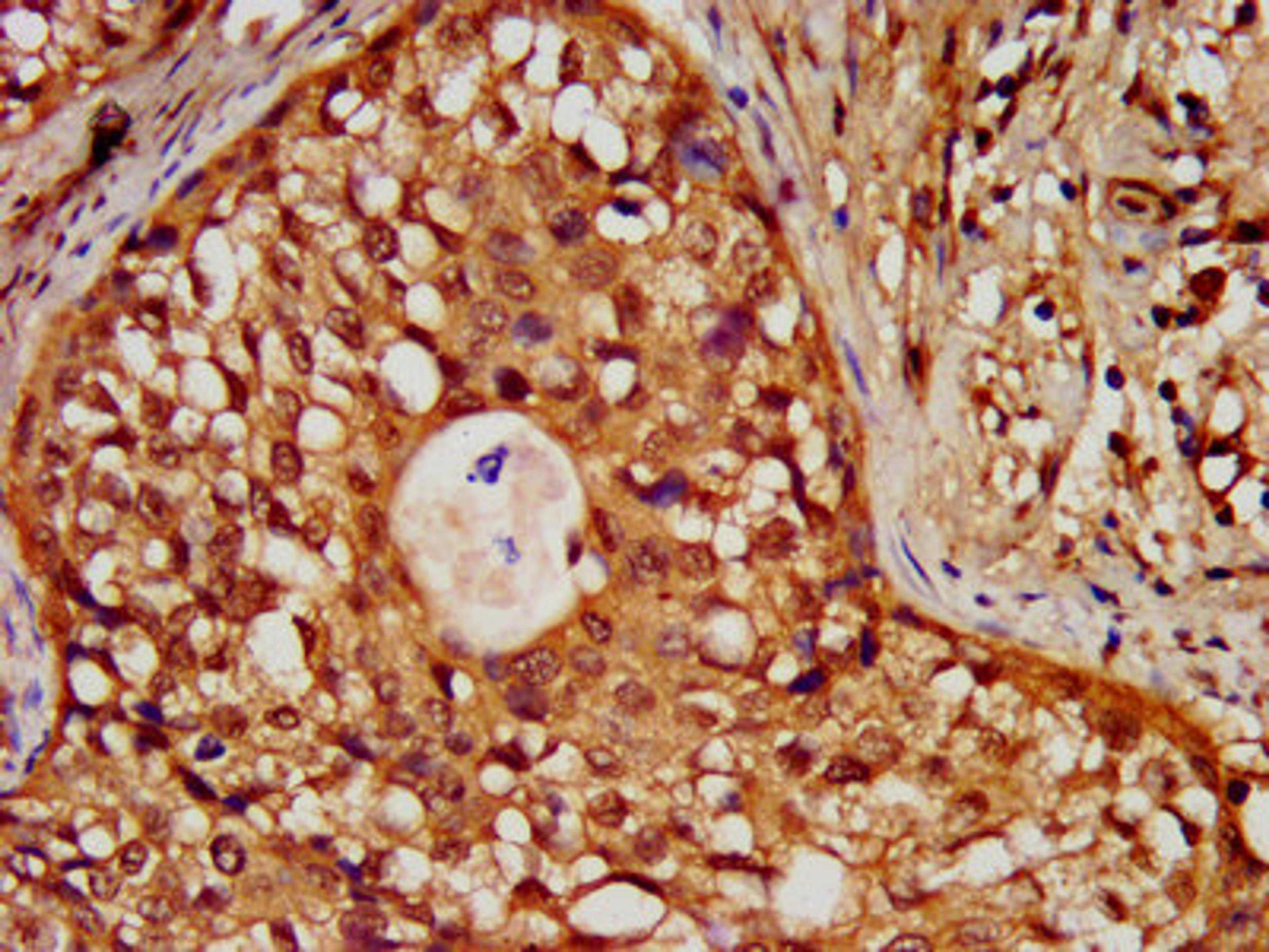 IHC image of CSB-PA010418OA18nforHU diluted at 1:30 and staining in paraffin-embedded human colon cancer performed on a Leica BondTM system. After dewaxing and hydration, antigen retrieval was mediated by high pressure in a citrate buffer (pH 6.0). Section was blocked with 10% normal goat serum 30min at RT. Then primary antibody (1% BSA) was incubated at 4&deg;C overnight. The primary is detected by a biotinylated secondary antibody and visualized using an HRP conjugated SP system.