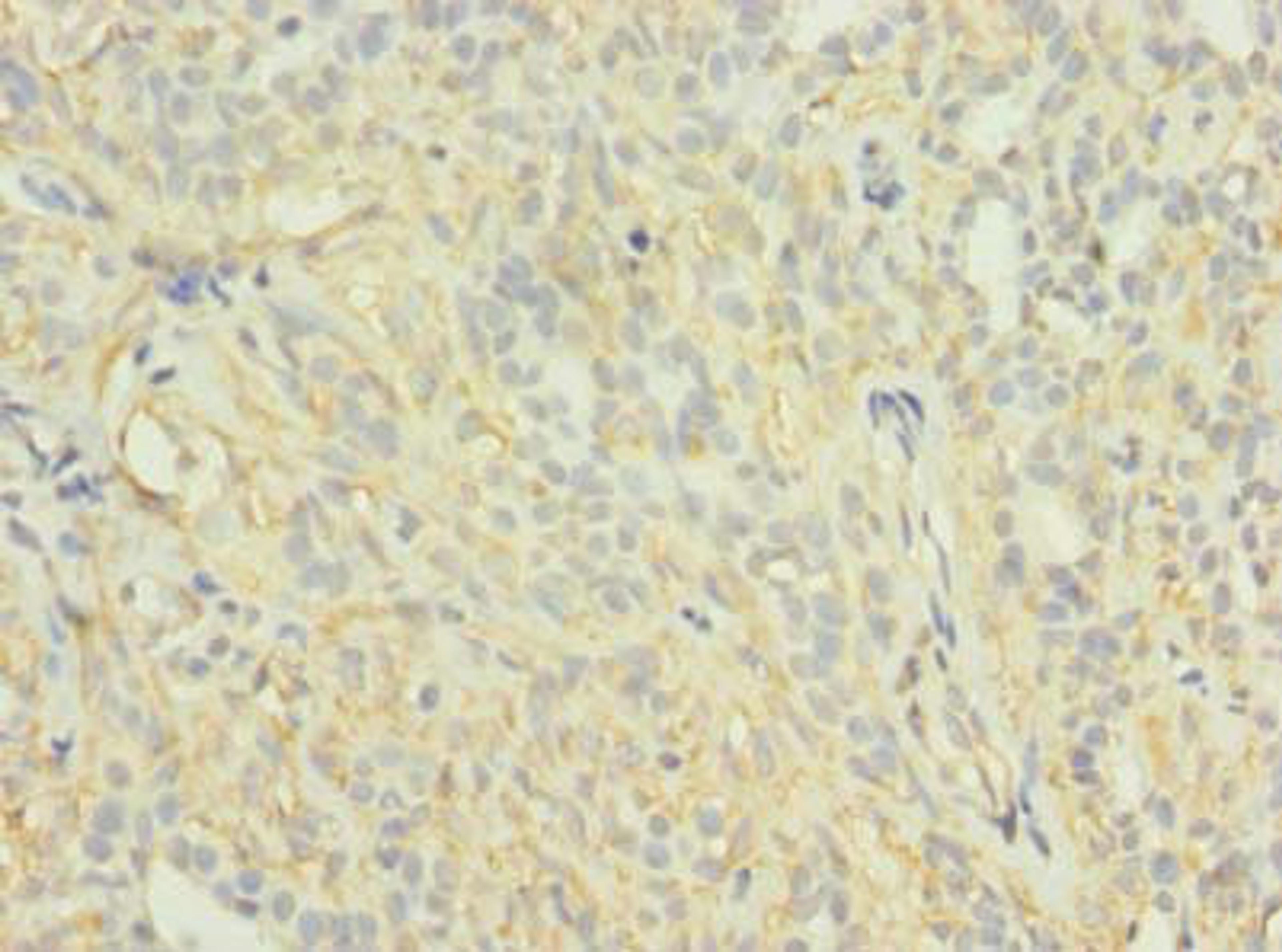 Immunohistochemistry of paraffin-embedded human breast cancer using CSB-PA878877LA01HU at dilution of 1:100