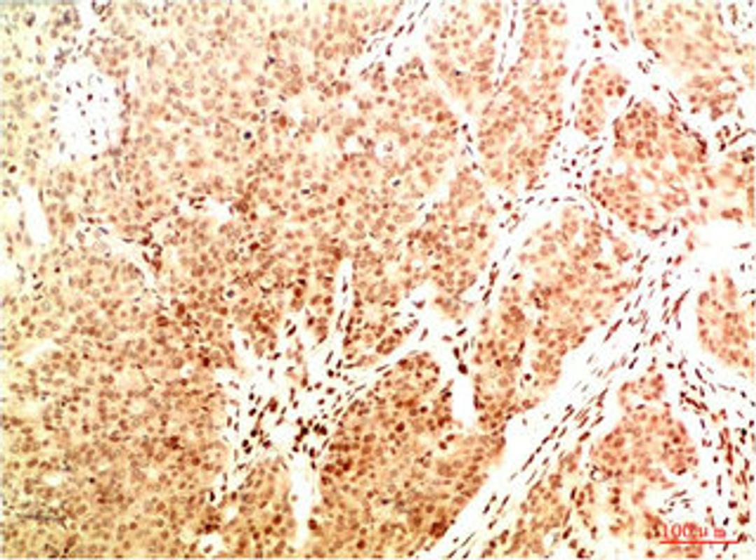 Immunohistochemical analysis of paraffin-embedded Human Breast Carcinoma Tissue using Acetyl NF kB P65(K314/K315) Mouse mAb diluted at 1:200.