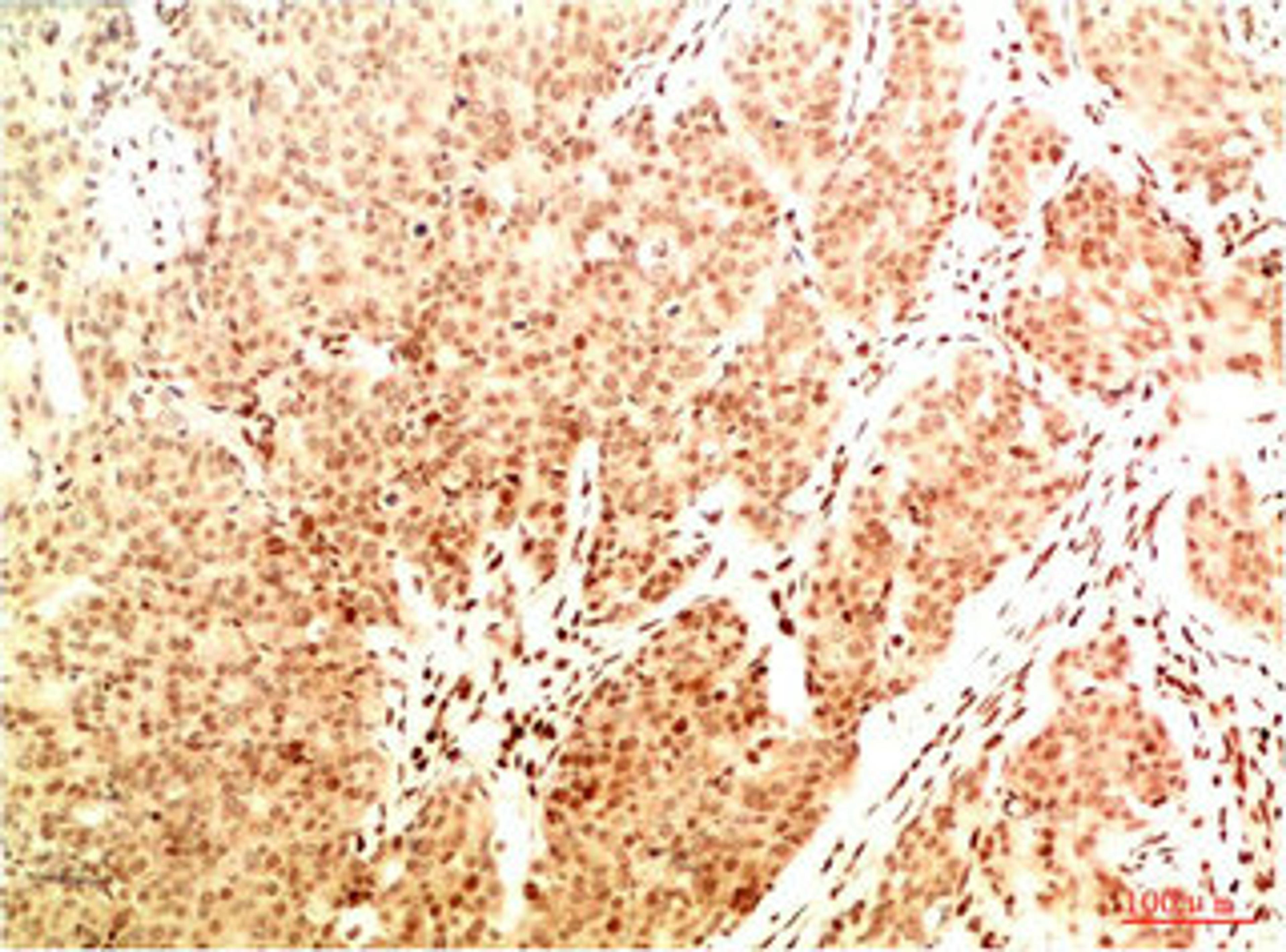 Immunohistochemical analysis of paraffin-embedded Human Breast Carcinoma Tissue using Acetyl NF kB P65(K314/K315) Mouse mAb diluted at 1:200.