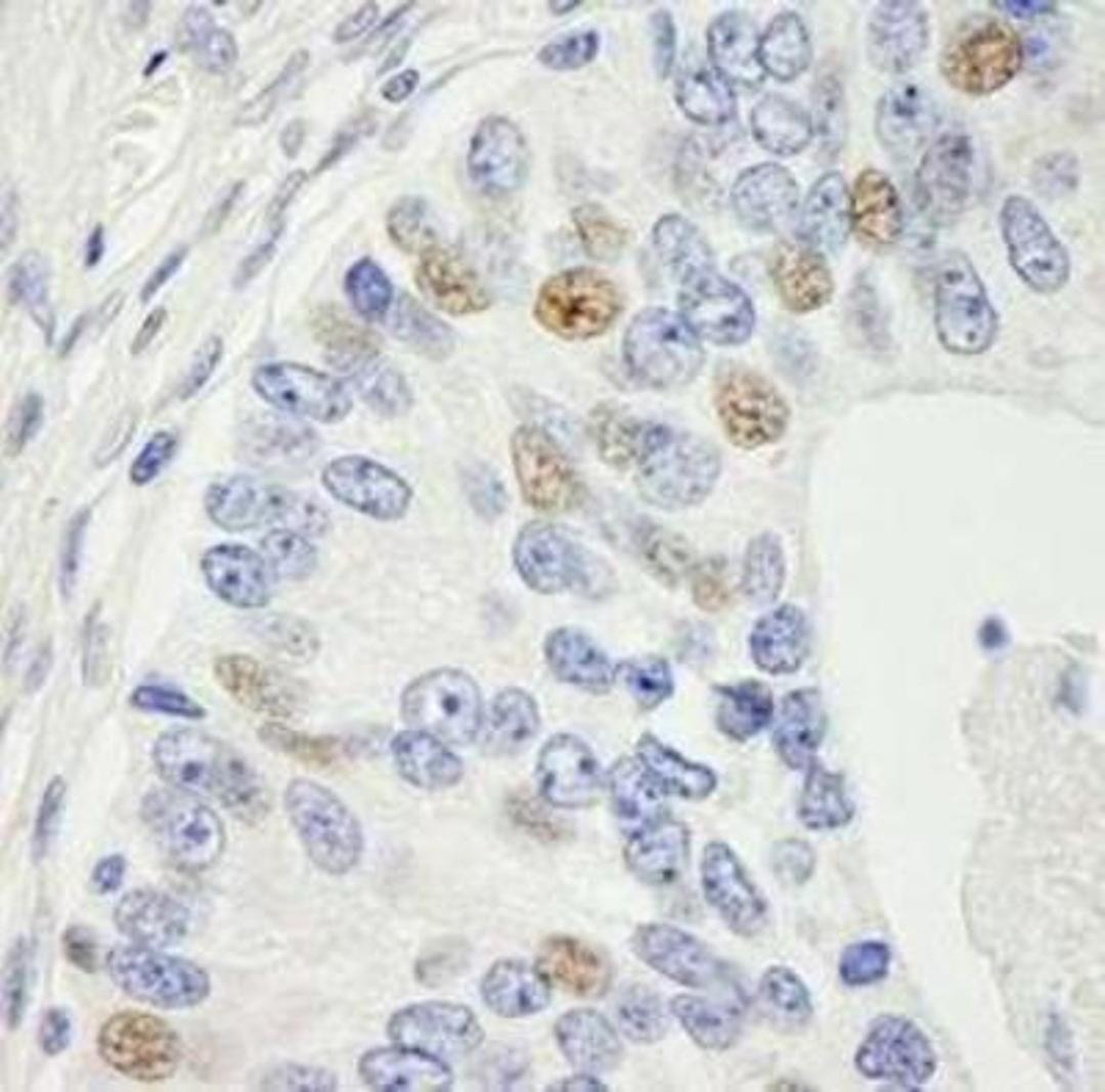 Immunohistochemistry-Paraffin: MAD1 Antibody [NB100-569] - FFPE section of human prostate adenocarcinoma.  Affinity purified rabbit anti-MAD1 used at a dilution of 1:250.