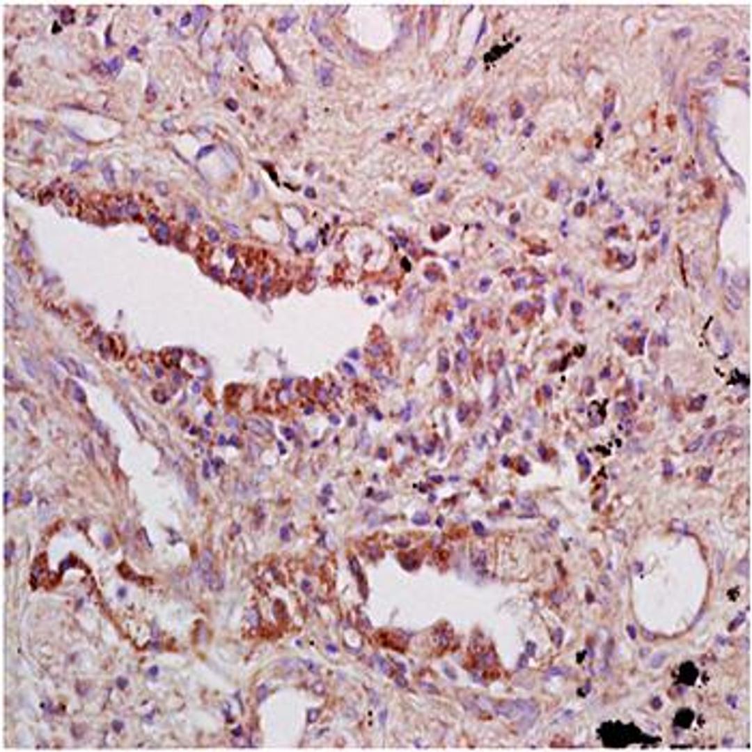 Paraffin-embedded human lung carcinoma fixed with 4% paraformaldehyde. Antigen retrieval by boiling with citrate buffer. Blocking buffer is goat serum (37 degrees for 20 min.). Tap1 antibody at 1:200 dilution with overnight incubation at 4 degrees