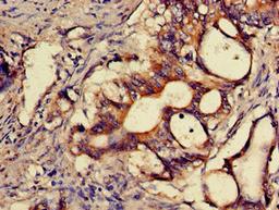 Immunohistochemistry of paraffin-embedded human colon cancer using CSB-PA882091LA01HU at dilution of 1:100
